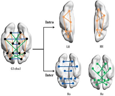 Prediction of Deep Brain Stimulation Outcome in Parkinson’s Disease With Connectome Based on Hemispheric Asymmetry